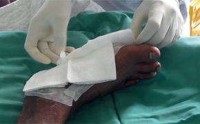 Mukisi Mukaza 教授借助远程指导对慢性伤口的治疗流程进行改进缩略图